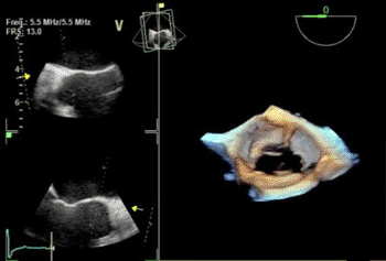 Image: The Vivid E9 Breakthrough 2012 includes a 4-D transducer for transesophageal echocardiography (TEE), as well as tools for workflow efficiencies (Photo courtesy of GE Healthcare).